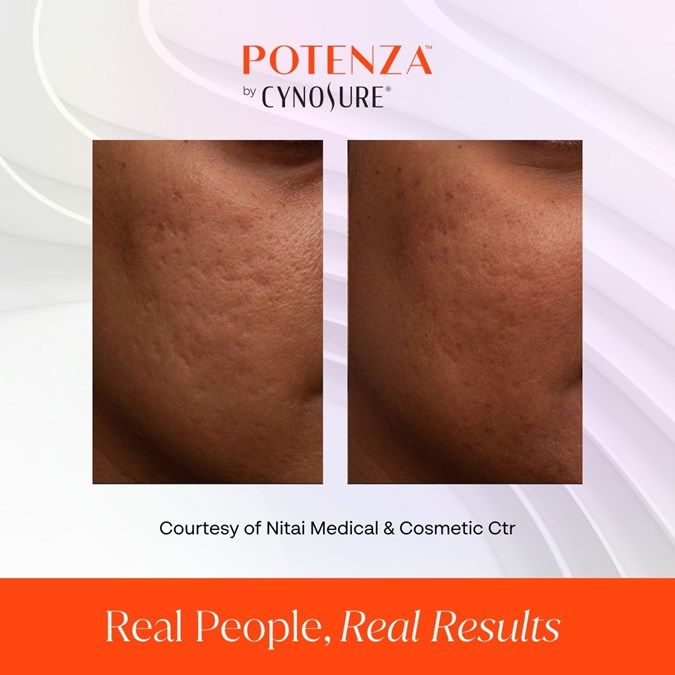 potenza avant apres Microneedling Cabinet Clairefeuille